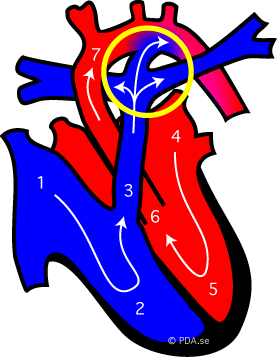 The fetal circulation, with wide open ductus arteriosus. Blood entering the right heart is short-cutting the pulmonary circulation and entering the systemic circulation.