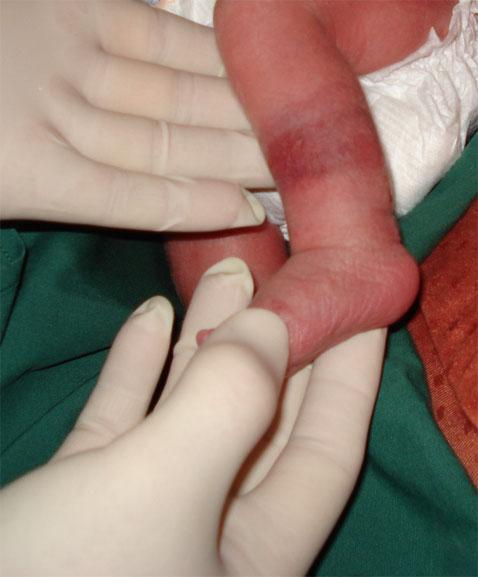 Amniotic band, 1 week postpartum