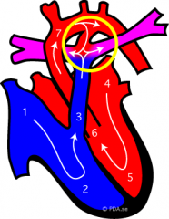 PDA, illustrating shunting of systemic blood to the pulmonary circulation.