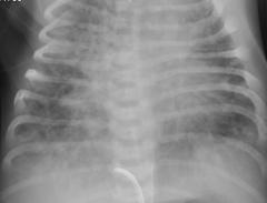 Meconium aspiration - plain x-ray