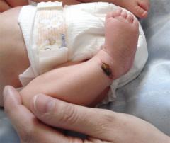 Amniotic band, 1 month postpartum