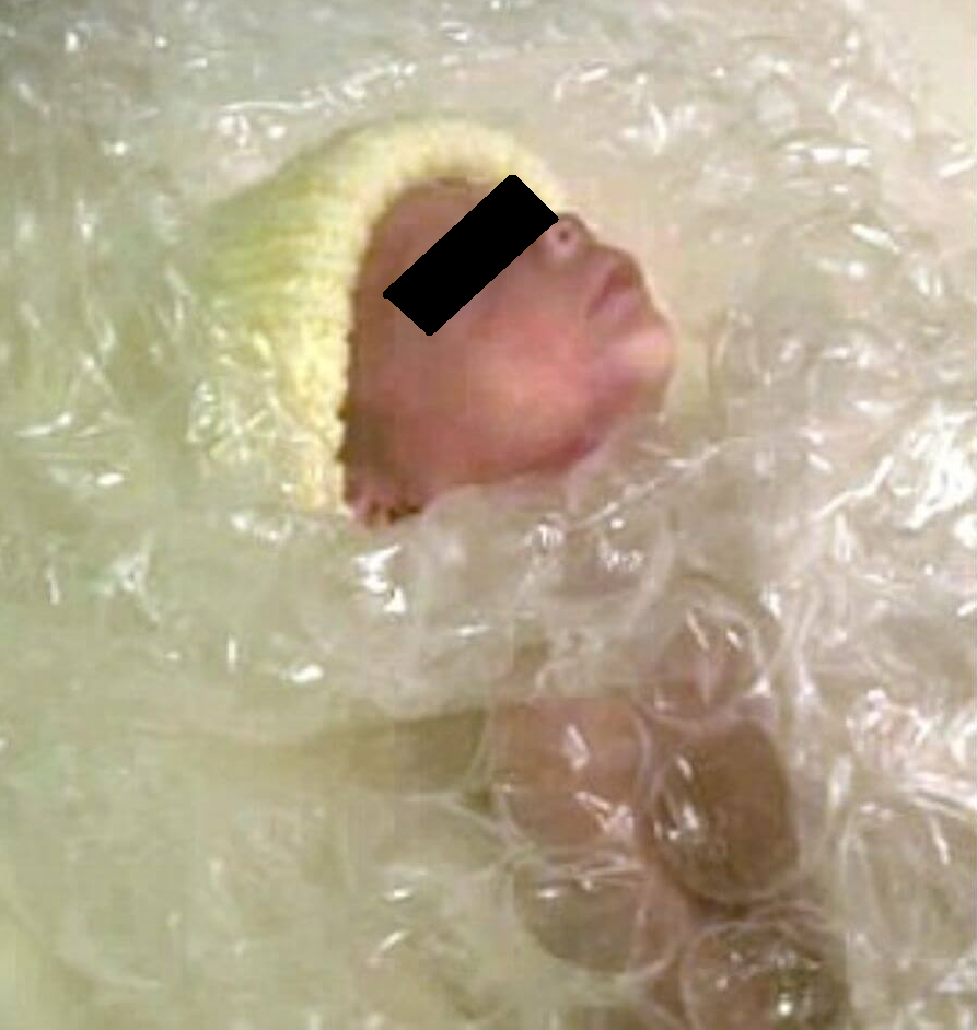 hypothermia and icterus - phototherapy?